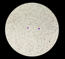 Dimorphic anemia analyzed by microscope. It is also called  iron- deficiency and macrocytic anemia.