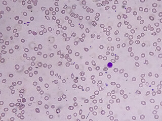 Macrocytic anemia with features of hemolysis and nucleated RBC analyzed by microscope. 