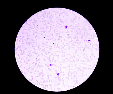 Macrocytic anemia with features of hemolysis and nucleated RBC analyzed by microscope. 