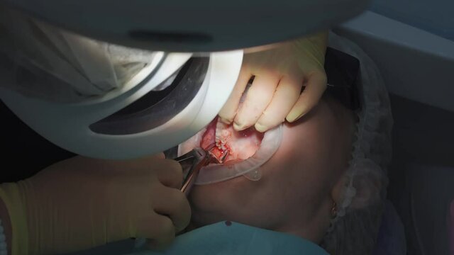 real. dentist pulls out a sick wisdom tooth. 