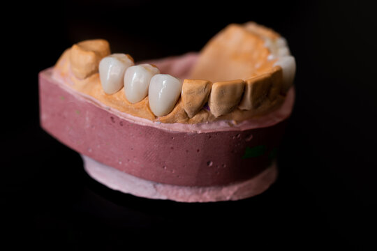 CARILLAS DENTALES
