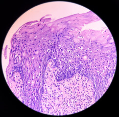 Tongue with mandible cancer, oral cancer, Invasive squamous cell carcinoma, grade-II....