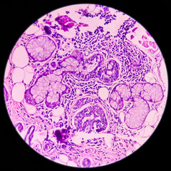 Tongue with mandible cancer, oral cancer, Invasive squamous cell carcinoma, grade-II. Lymphovascular invasion present, microscopic view.