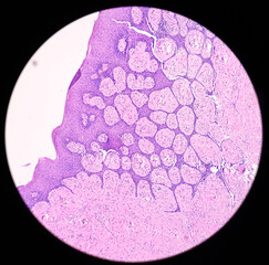 Tongue with mandible cancer, oral cancer, Invasive squamous cell carcinoma, grade-II. Lymphovascular invasion present, microscopic view.