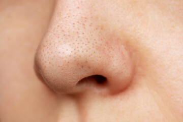 Close-up of a female nose with blackheads or black dots. Acne problem, comedones. Enlarged pores on...