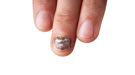 Onycholysis, Detachment Of Nail From Nailbed. Exfoliation of nail on a finger, close-up. Toenail...