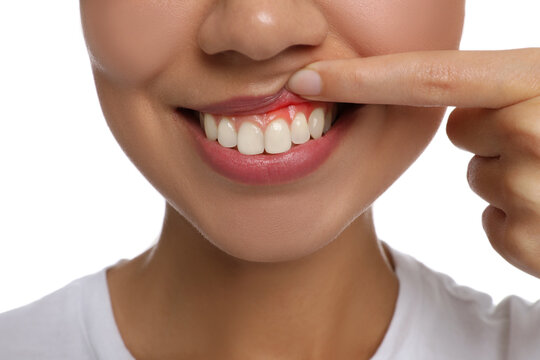 Young woman showing inflamed gums, closeup view