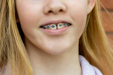 Close up of a teenage girl wearing metal braces. Orthodontic dental braces teeth straighteners. Gap between front teeth