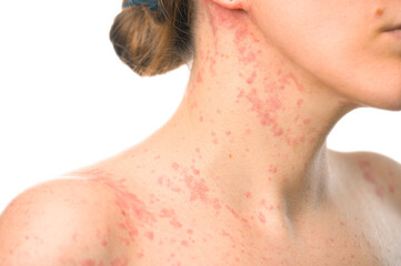 A girl's neck covered with an allergic rash close-up on a white background.