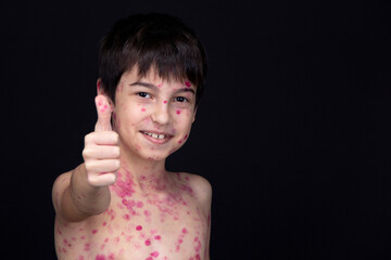 Chickenpox virus. Skin rash in a child.  Thumbs up. 8 year old boy