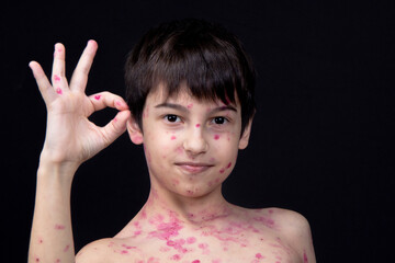 A boy aged 8 years old is gesturing OK. Chickenpox virus. Skin rash in a child. - obrazy, fototapety, plakaty