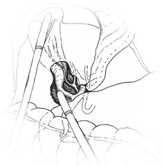 The Critical View of Safety, Calot's Triangle - Illustration, Drawing of a Laparoscopic Cholecystectomy