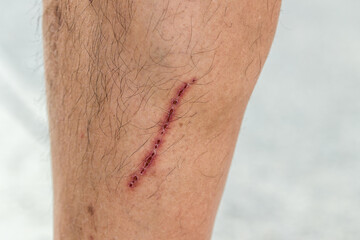 close up scar on skin. The wound form scabs on leg. Man with long scab wound on  right leg.