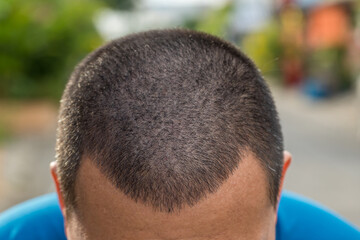 Man with short hair. Hair loss concept. Head of man