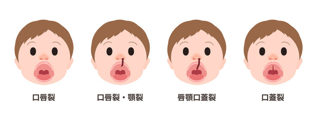 口唇口蓋裂_開口時の口唇裂・顎裂・口蓋裂のイラスト