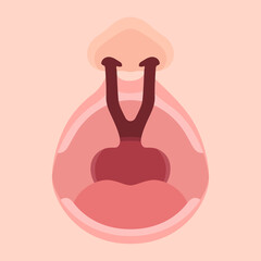 口唇口蓋裂_両側性唇顎口蓋裂のイラスト_アップ