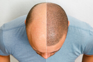 The head of a balding man before and after hair transplant surgery. A man losing his hair has become shaggy. An advertising poster for a hair transplant clinic. Treatment of baldness. - obrazy, fototapety, plakaty