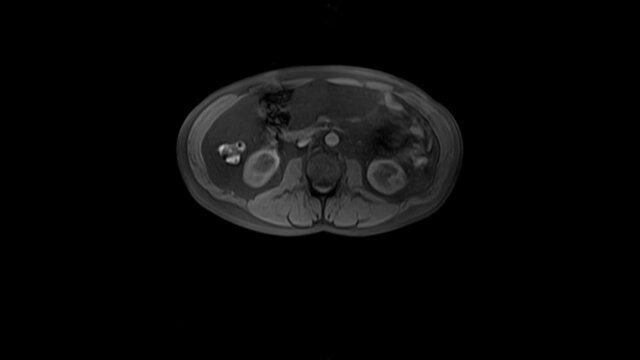 CT scan of the abdomen. Computed tomography of the gastrointestinal tract, liver and kidneys.