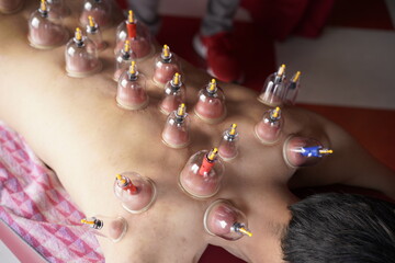 吸い玉とカッピング