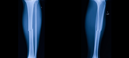 A photo of plain radiograph on dark background in hospital. The film use for diagnosis the illness...