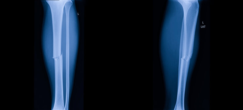 A photo of plain radiograph on dark background in hospital. The film use for diagnosis the illness of patient.Medical concept. A man with fracture tibia bone. A leg fracture.