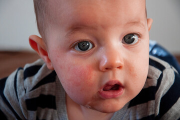 Pięciomiesięczny chłopiec ze skazą białkową. Reakcja alergiczna widoczna na policzkach. Atopowe zapalenie skóry - obrazy, fototapety, plakaty