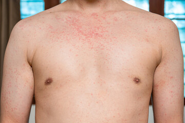 Dermatitis rash viral disease with immunodeficiency on body of young adult asian, scratch with itch