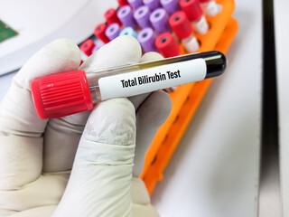 Scientist hold blood sample for Total bilirubin test, diagnosis of liver diseases