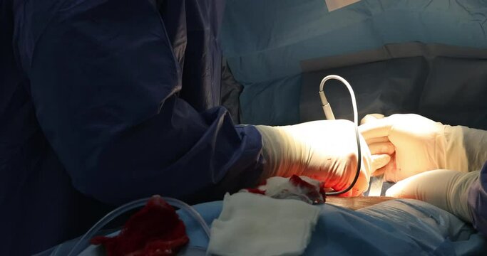 Open heart surgery with different surgical tubes connected to a coronary artery bypass heart close up
