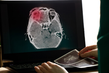 computed tomography of the brain with a fracture of the frontal part of the skull after injury on...