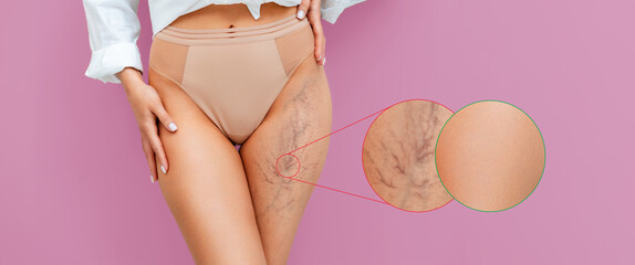 Banner of varicose veins. A slender woman in lingerie and a white shirt poses on a pink background,...
