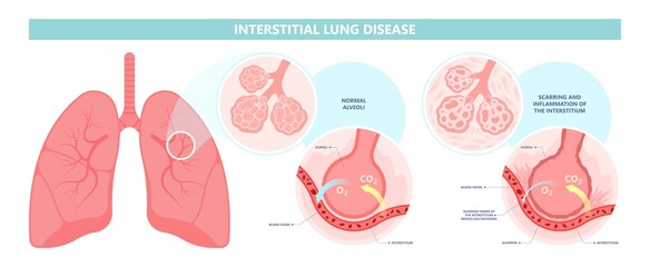 Capillary dry cough of wood metal dust breath virus Chest X-ray Cancer scan High resolution HRCT Biopsy usual COPD chronic asbestos corona covid 19 cystic diagnose disorder dyspnea fibers ILD UIP IPF