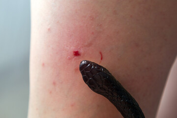 Venomous snake bite in a man's leg close-up.