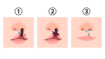 口唇口蓋裂_手術方法のイラスト_鬼塚法_三角弁法+ミラード法