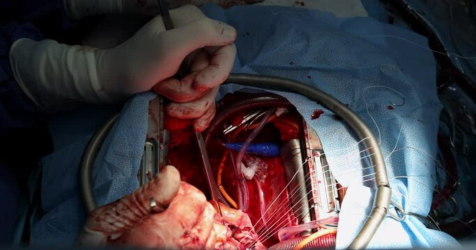 Close up of implantation of a biological heart valve cardiovascular surgery team open heart surgery