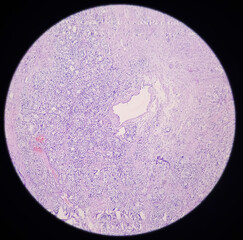 Prostatic chips: Microphotograph show focal area of adenocarcinoma, moderately differentiated,...
