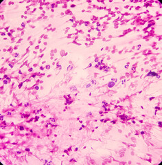 Pancreatic mass(CT Guided FNA): Positive malignant cell, adenocarcinoma, atypical epithelial cells, pleomorphism with prominent nuclei and cytoplasm, chronic inflammatory cells.