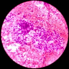 Pancreatic mass(CT Guided FNA): Positive malignant cell, adenocarcinoma, atypical epithelial cells,...