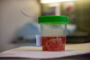  tissue sample is placed in a formalin-filled cup after an operation