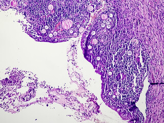 Uterus wall: Simple endometrial hyperplasia, show revealing features of simple endometrial hyperplasia, no malignant cells present.