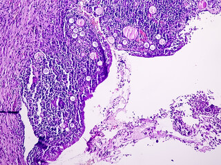 Leiomyoma, or fibroids, is a smooth muscle benign tumors, light micrograph, photo under microscope