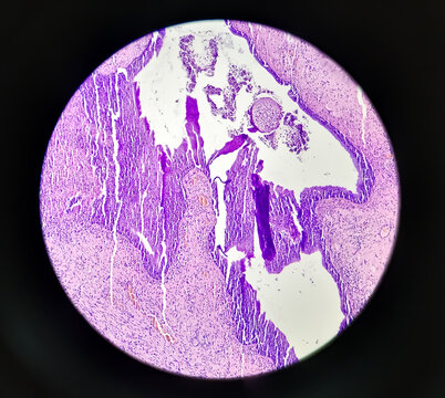 Inflammatory breast lump, Chronic nonspecific mastitis with fibrocystic changes and ductal hyperplasia, no malignant cell.