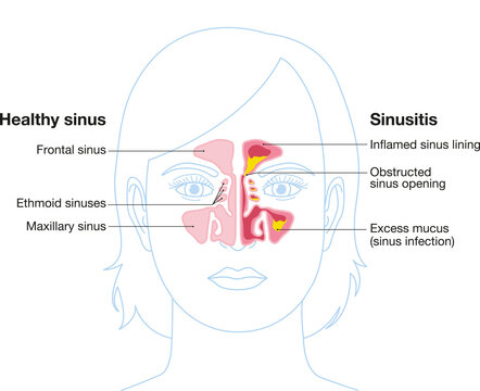 Sinusitis, vector illustration, labeled