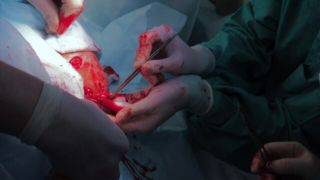 Surgeons use medical instruments to suture human skin during proctological minimally invasive surgery on the anus. Close-up of hands in sterile gloves, covered with blood. Blue uniform and masks.