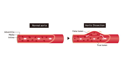 Comparison illustration of normal aorta and aortic dissection