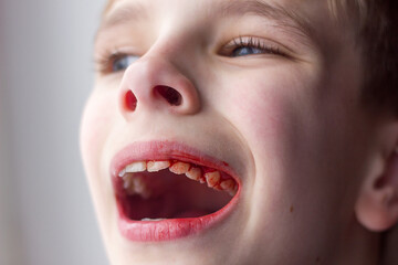 Unfocused face of boy with open mouth and blood on teeth, pediatric dentistry disease and dental and oral cavity treatment - obrazy, fototapety, plakaty
