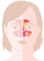 Healthy sinus and sinusitis, medical illustration - obrazy, fototapety, plakaty