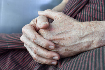 Clasped hands of Asian elder man. Concept of rheumatoid arthritis, osteoarthritis or joint pain.
