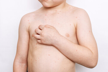 Cropped shot of a child with a red rash on his body scratching the skin isolated on a white background. Chickenpox, measles, allergies, dermatitis, herpes, virus