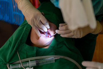 Dental scrubs cleaning and tooth filling teeth in a dental clinic - Concept of oral hygiene and teeth polishes.